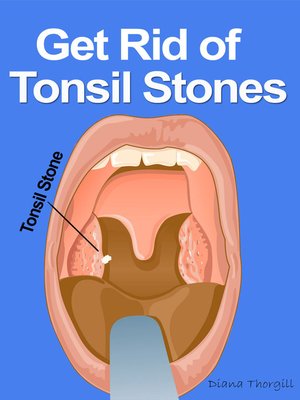 cover image of Get Rid of Tonsil Stones